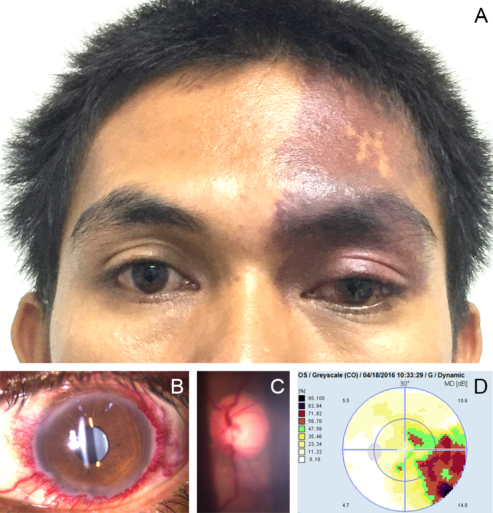 Figure 1   
		Flat, well-defined, violaceous red patch with irregular borders (port-wine stain) on the left frontal area (A). Dilated and tortuous perilimbal vessels in the left conjunctiva (B). Cup-to-disc ratio of 0.7 and tortuous and dilated vessels on funduscopy of the left eye (C). Report of automated perimetry test showing left temporal quadrantanopsia (D).